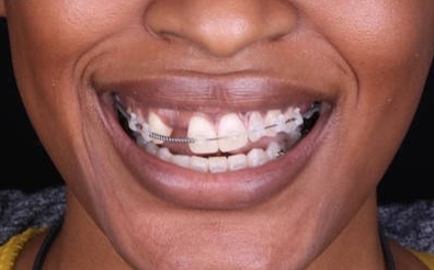 Before